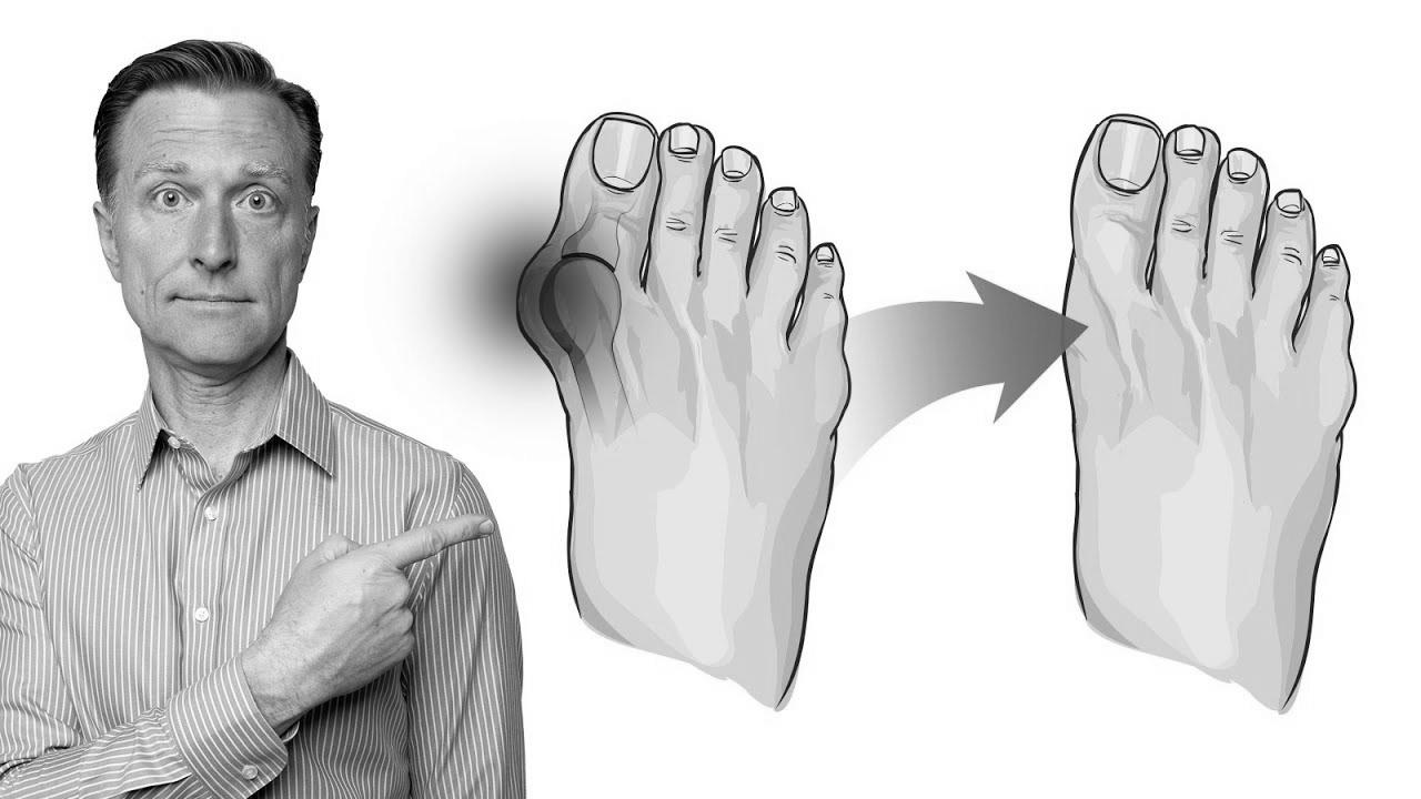  Fix Bunions in 3 Steps