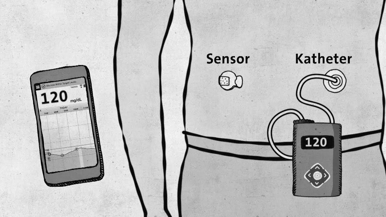 Type 1 diabetes – fashionable technology without approval – good to know